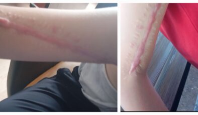 Eldivan Bakım Merkezinde Engelli Çocuğun Yaralanmasıyla İlgili Kamu Davası Açıldı